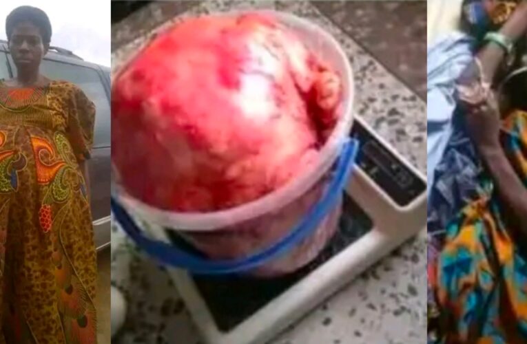 💔 HEARTBREAKING: Woman Reportedly D¡es After Complications During Surgery to Remove Massive Fibroid